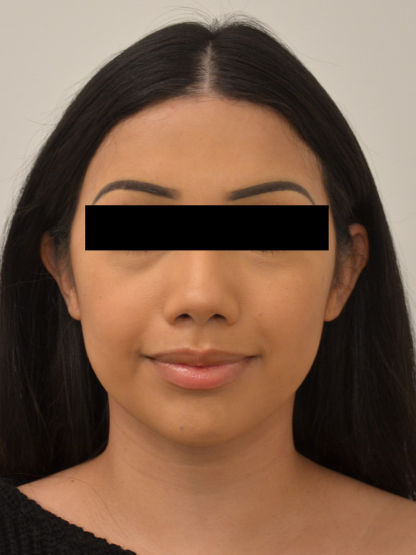 Hairline Lowering Before & After Image