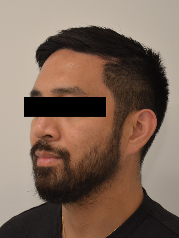 Hairline Lowering Before & After Image