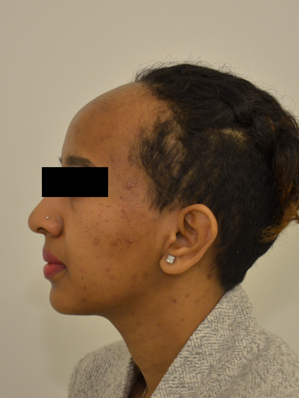 Hairline Lowering Before & After Image