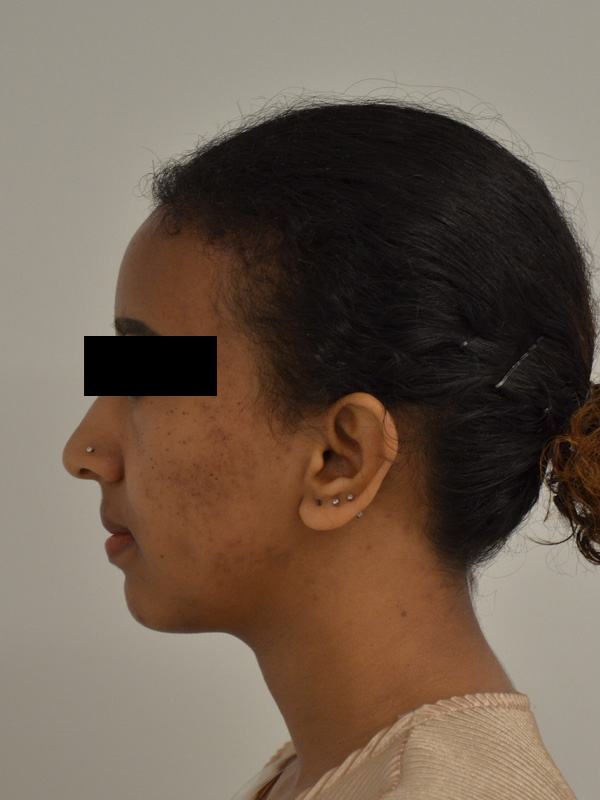 Hairline Lowering Before & After Image