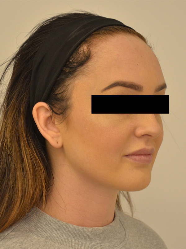 Hairline Lowering Before & After Image