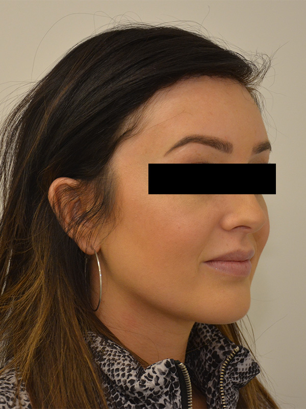 Hairline Lowering Before & After Image