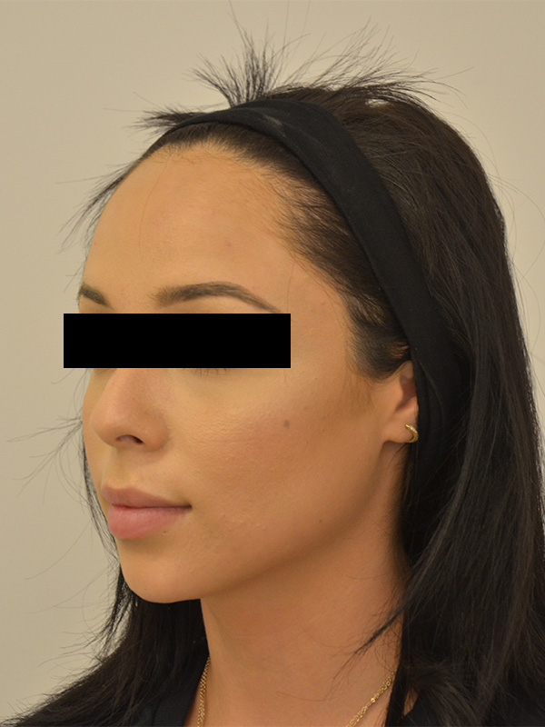 Hairline Lowering Before & After Image