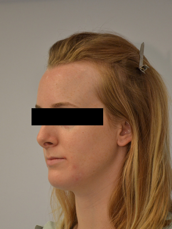 Hairline Lowering Before & After Image