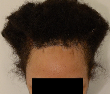 Hairline Lowering Before & After Image