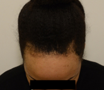 Hairline Lowering Before & After Image