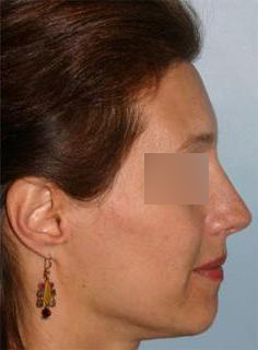 Hairline Lowering Before & After Image