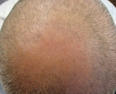 Hair Loss: There's a (Red) Light at the End of the Tunnel