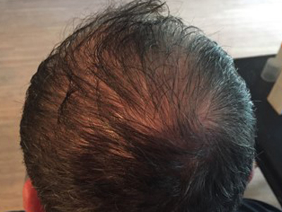 Prp For Hair Loss Before & After Image