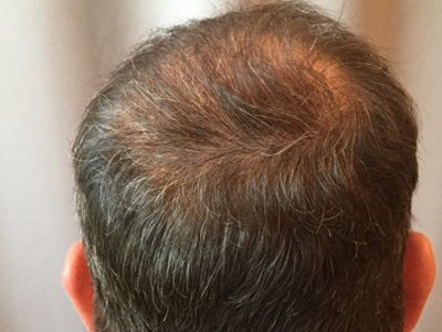 Prp For Hair Loss Before & After Image