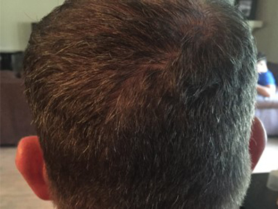 Prp For Hair Loss Before & After Image