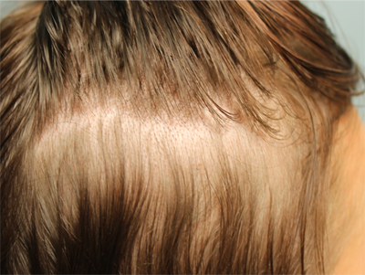 Prp For Hair Loss Before & After Image