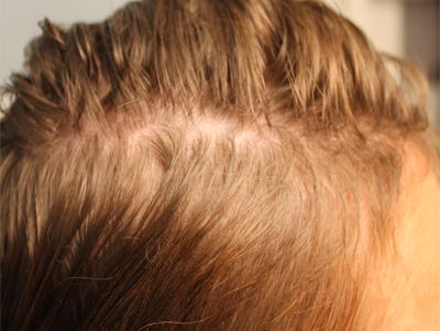 Prp For Hair Loss Before & After Image