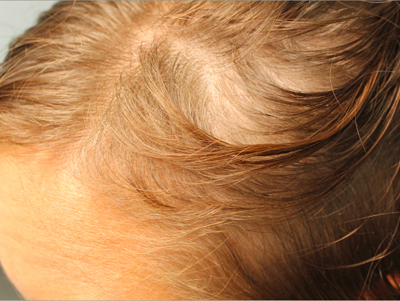 Prp For Hair Loss Before & After Image