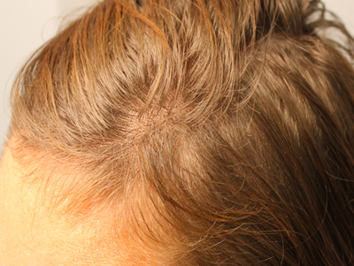 Prp For Hair Loss Before & After Image