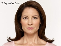 Dermal Fillers Before & After Image