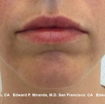 Dermal Fillers Before & After Image