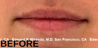 Dermal Fillers Before & After Image