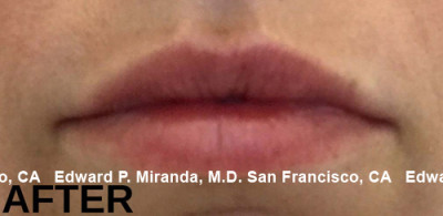 Dermal Fillers Before & After Image