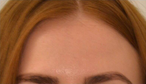 Dermal Fillers Before & After Image