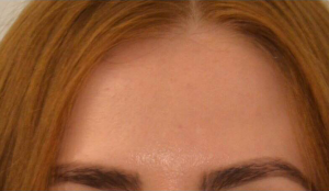 Dermal Fillers Before & After Image