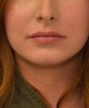 Dermal Fillers Before & After Image