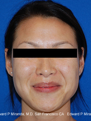 Dermal Fillers Before & After Image