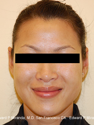 Dermal Fillers Before & After Image