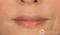 Dermal Fillers Before & After Image