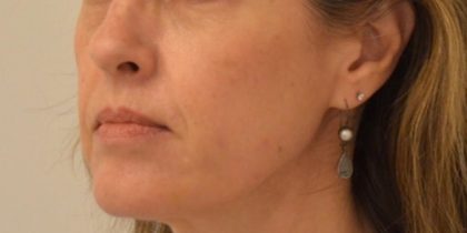 Dermal Fillers Before & After Image