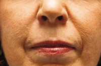 Dermal Fillers Before & After Image