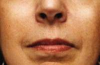 Dermal Fillers Before & After Image