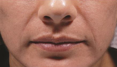 Dermal Fillers Before & After Image