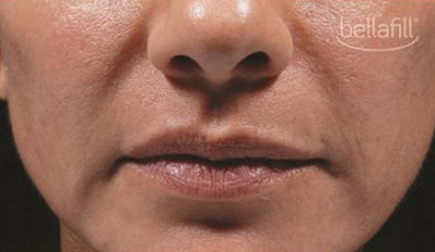 Dermal Fillers Before & After Image