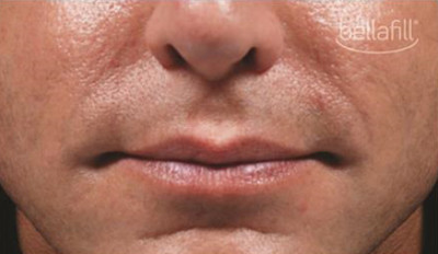 Dermal Fillers Before & After Image