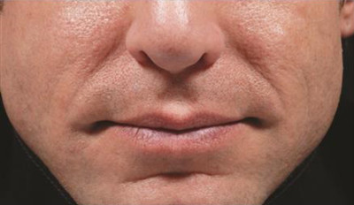 Dermal Fillers Before & After Image