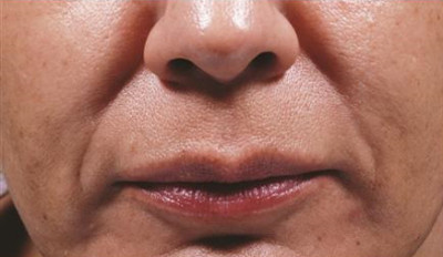 Dermal Fillers Before & After Image