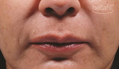 Dermal Fillers Before & After Image