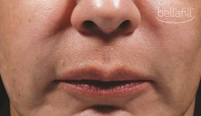 Dermal Fillers Before & After Image