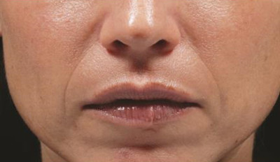 Dermal Fillers Before & After Image