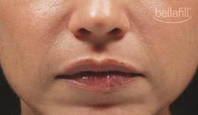 Dermal Fillers Before & After Image