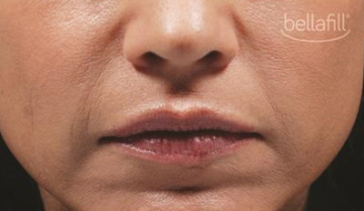 Dermal Fillers Before & After Image