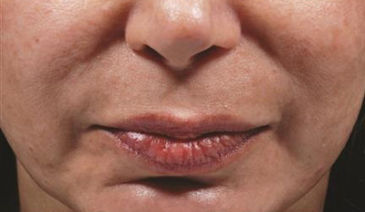 Dermal Fillers Before & After Image