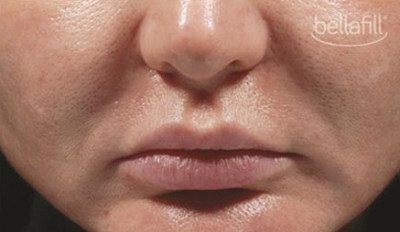 Dermal Fillers Before & After Image