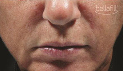 Dermal Fillers Before & After Image