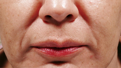 Dermal Fillers Before & After Image