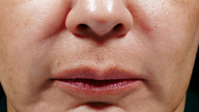 Dermal Fillers Before & After Image