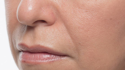 Dermal Fillers Before & After Image