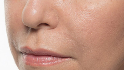 Dermal Fillers Before & After Image