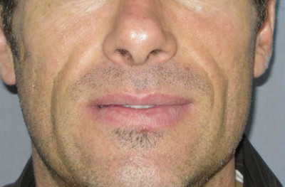 Dermal Fillers Before & After Image